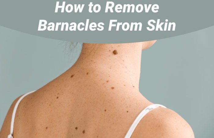 How to Remove Barnacles From Skin