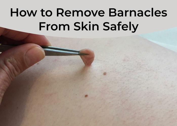 how to remove barnacles from skin safely