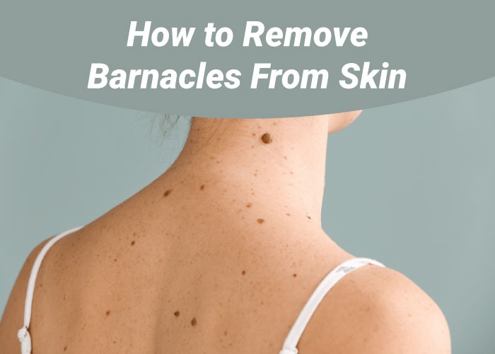 how to remove barnacles from skin