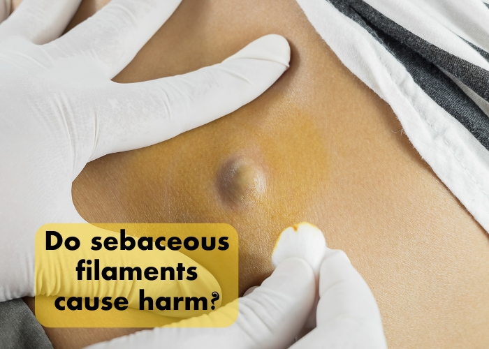 Do sebaceous filaments cause harm?