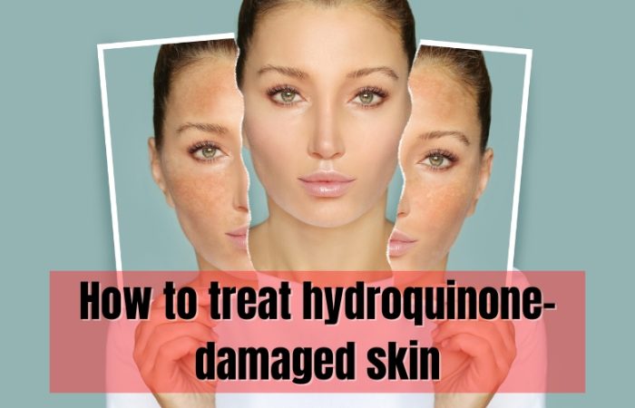 How to treat hydroquinone-damaged skin