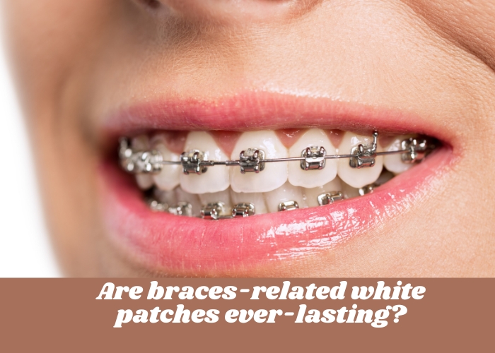 Are braces-related white patches ever-lasting