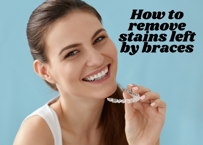 How to remove stains left by braces